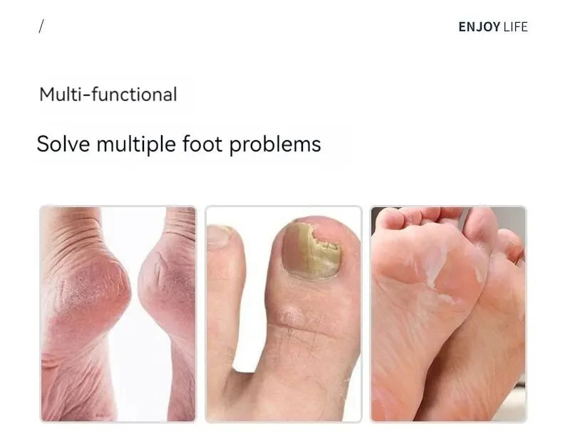 Skin Scraper Home Pedicure Knife Set Of Callus Nail Trimming Tools To Remove Dead  Repair Foot Nail Groove Artifacts